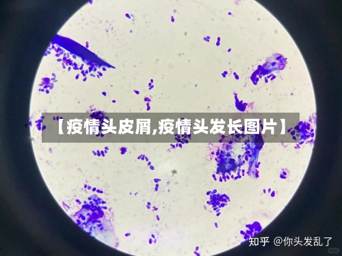 【疫情头皮屑,疫情头发长图片】-第2张图片